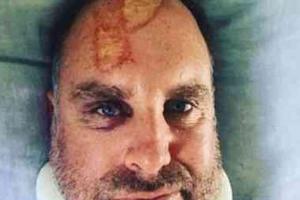 ਹੇਡਨ ਸਰਫਿੰਗ ਦੌਰਾਨ ਗੰਭੀਰ ਜ਼ਖ਼ਮੀ