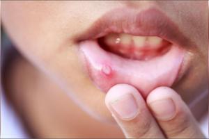 Mouth Ulcers Remedy: ਨਾਰੀਅਲ ਤੇਲ ਤੋਂ ਲੈ ਕੇ ਹਲਦੀ ਤੱਕ, ਤੁਹਾਨੂੰ ਮੂੰਹ ਦੇ ਛਾਲਿਆਂ ਤੋਂ ਰਾਹਤ ਮਿਲੇਗੀ