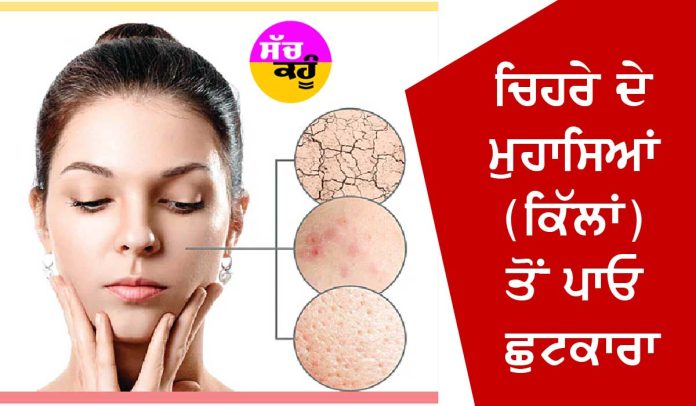 Get rid of facial acne