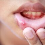 Mouth Ulcers Remedy