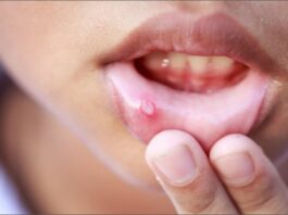 Mouth Ulcers Remedy