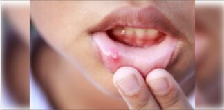 Mouth Ulcers Remedy