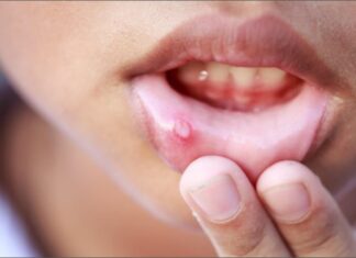 Mouth Ulcers Remedy