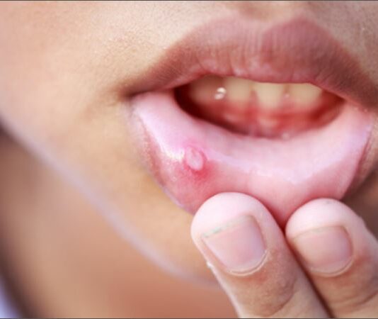 Mouth Ulcers Remedy