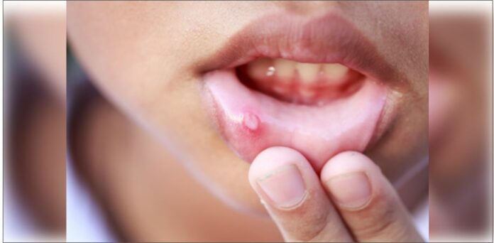 Mouth Ulcers Remedy