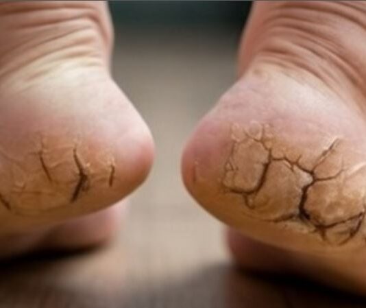 Cracked Heels: ਆਯੁਰਵੈਦਿਕ ਉਪਾਅ ਨਾਲ ਫਟੀ ਅੱਡੀਆਂ ਤੋਂ ਮਿਲੇਗਾ ਛੁਟਕਾਰਾ, ਕਰਨਾ ਪਵੇਗਾ ਬਸ ਇਹ ਕੰਮ… Cracked Heels