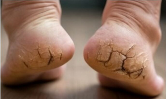 Cracked Heels Cracked Heels